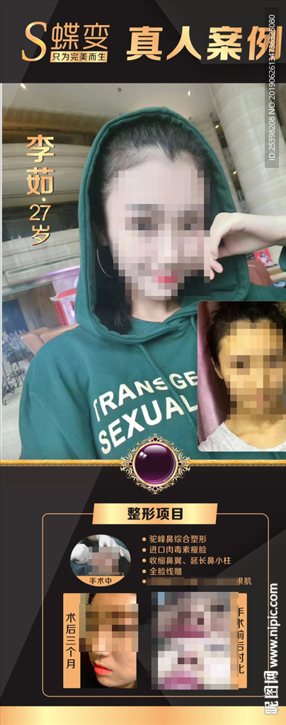隆鼻线雕肉毒素案例