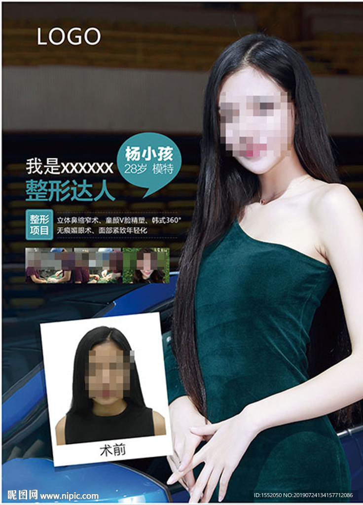 双眼皮案例