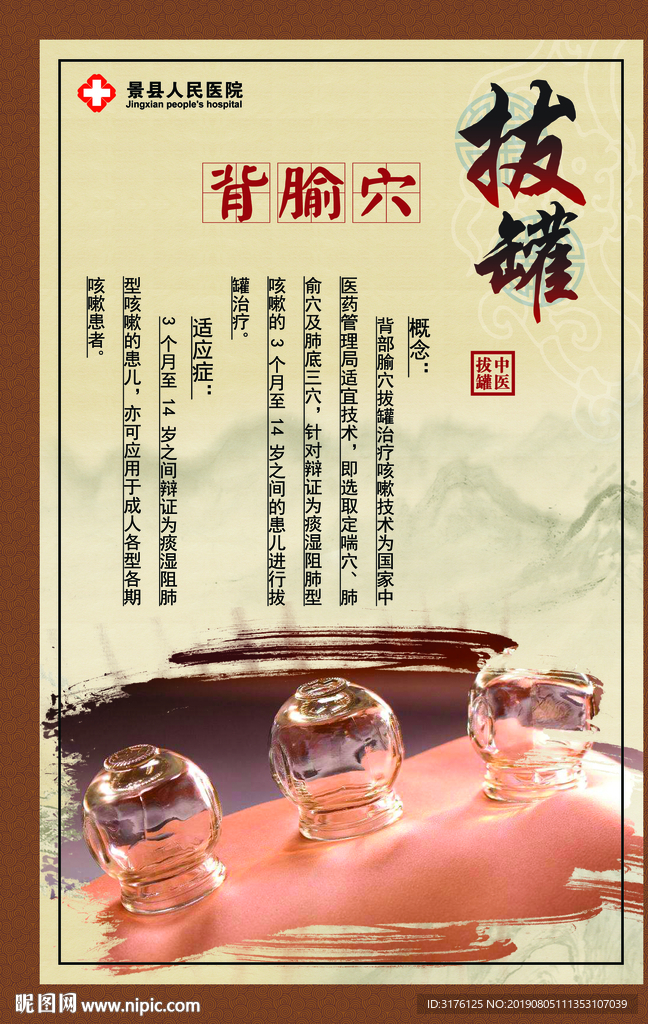 中医拔罐 背腧穴 针灸治疗