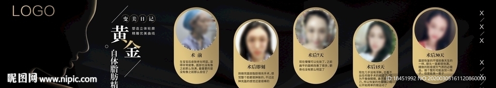 自体脂肪填充变美日记