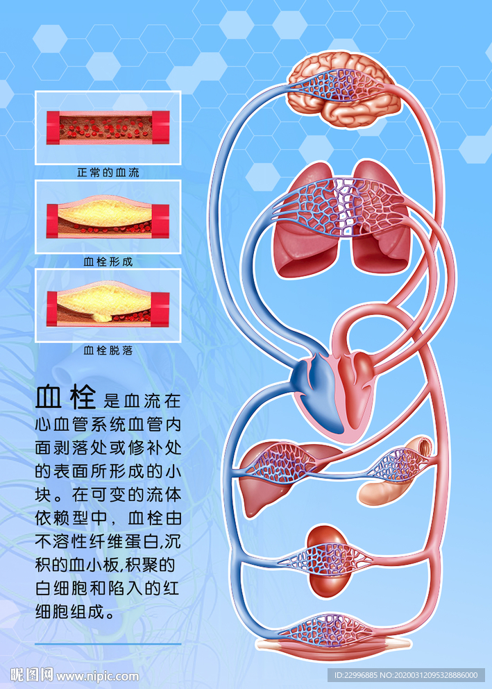 医疗血栓展板