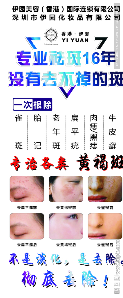 雀斑牛皮癣老年斑胎记