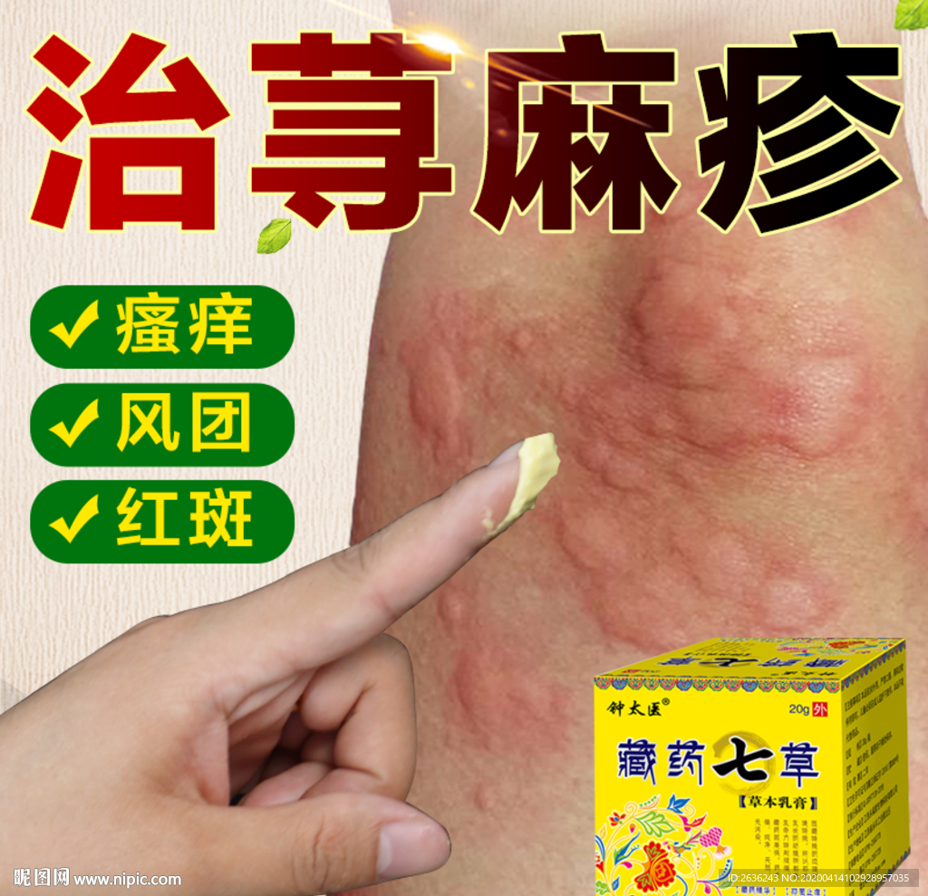 荨麻疹