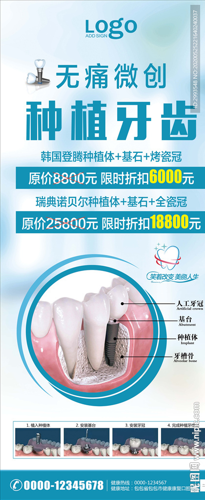 牙科 种植牙图片