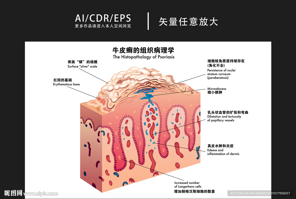 矢量医学牛皮癣图解插画