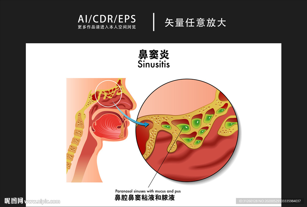 矢量医学鼻窦炎图解插画
