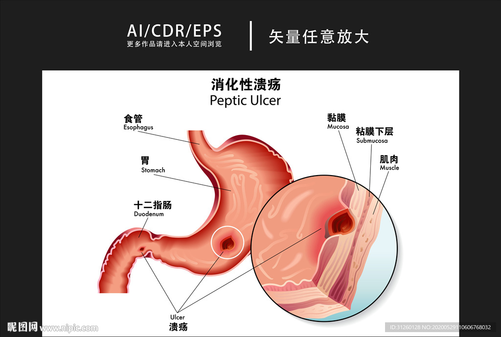 矢量医学消化性溃疡图解插画