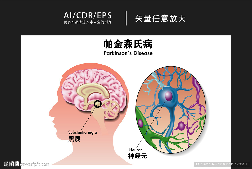 矢量医学帕金森氏病图解插画