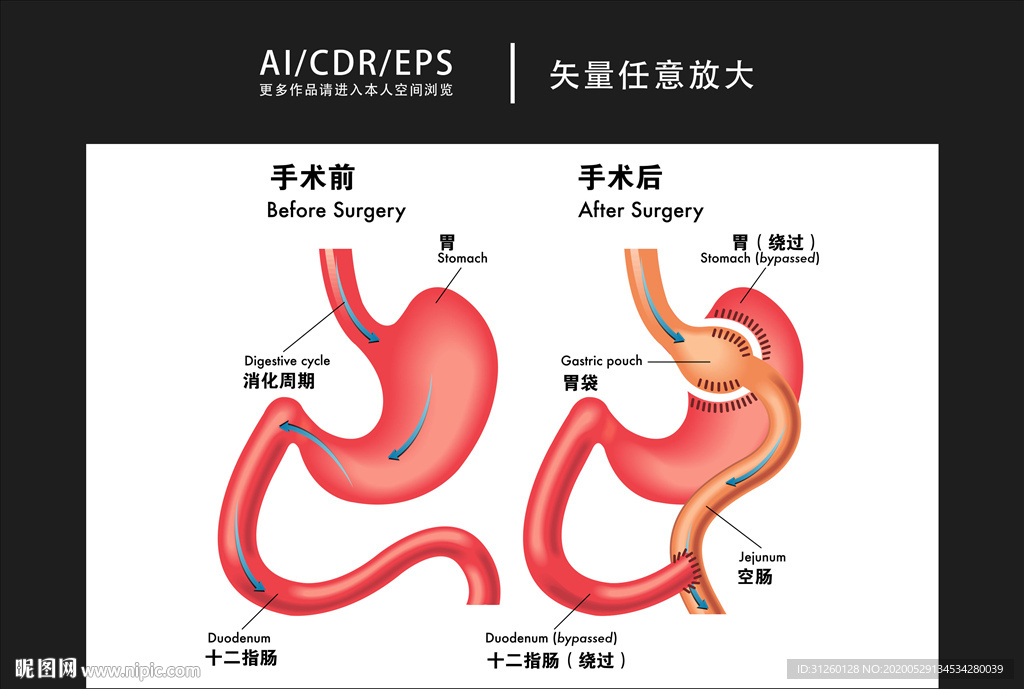 矢量医学肺部手术图解插画