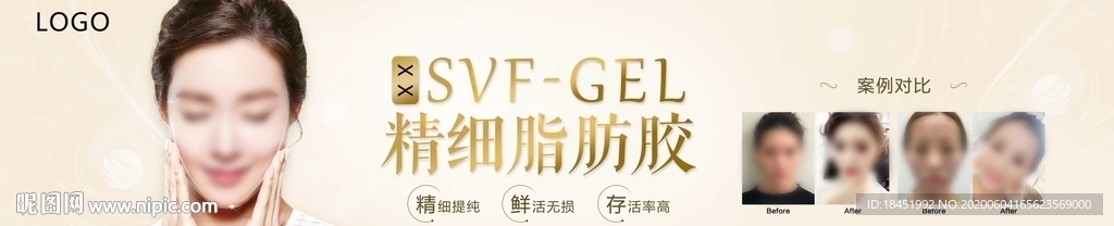 SVF-GEL脂肪胶填充