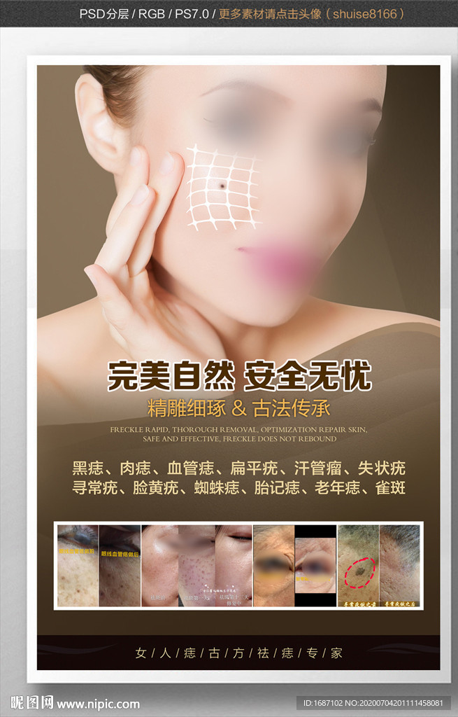 点痣