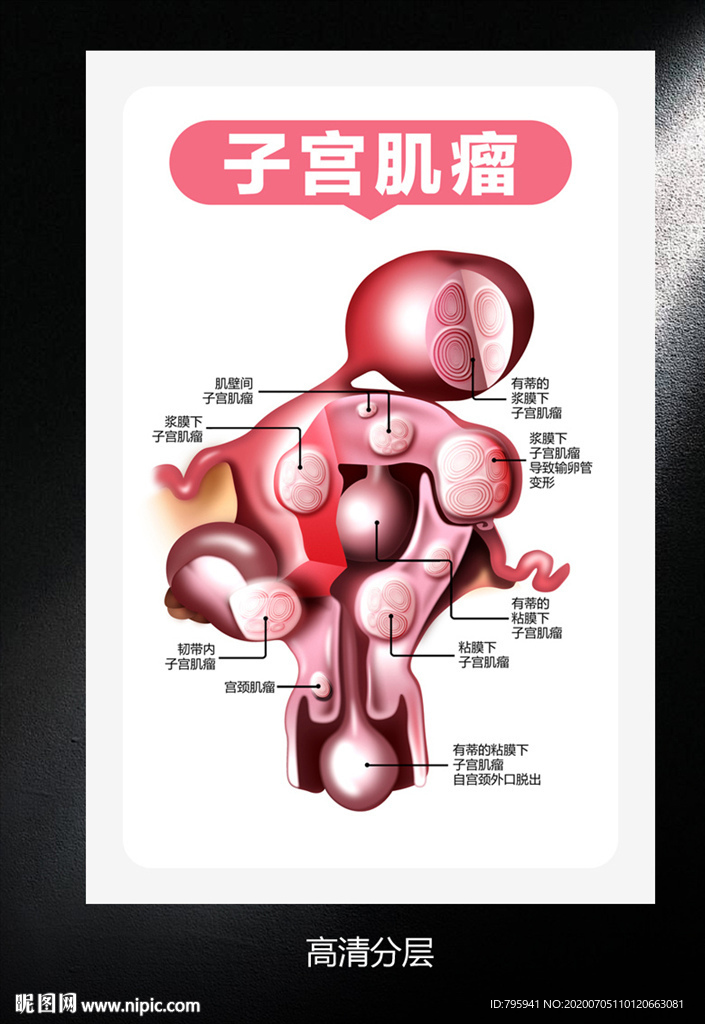 子宫肌瘤高清分层图