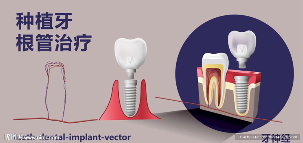 牙齿治疗 种植牙结构图