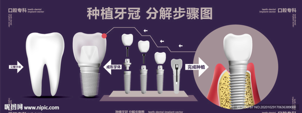 种植牙冠 分解步骤图