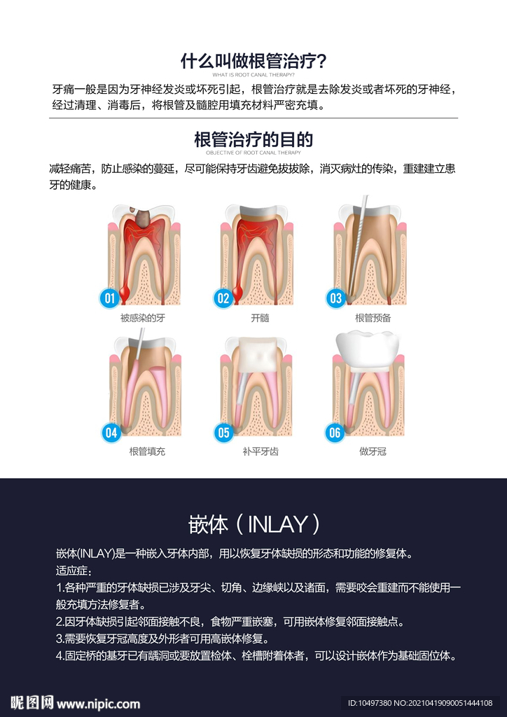 根管治疗