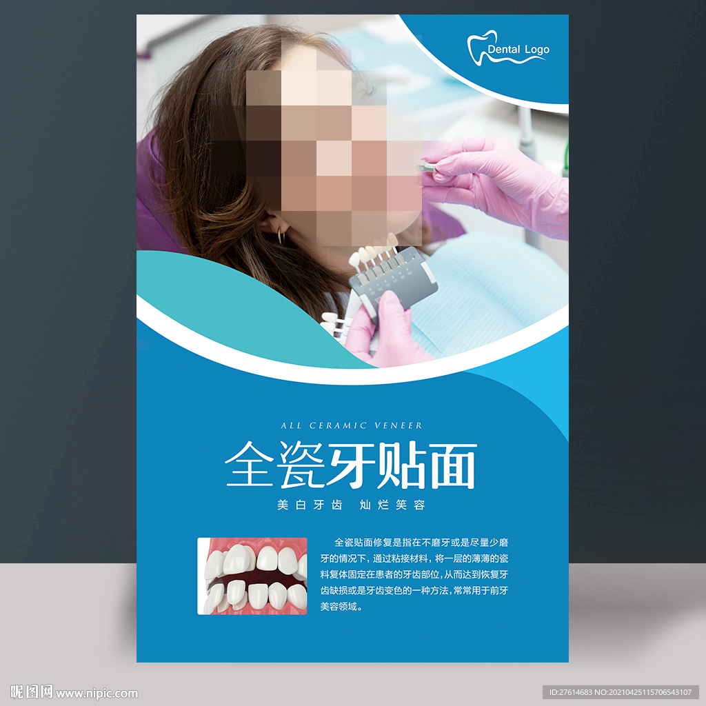 全瓷牙贴面