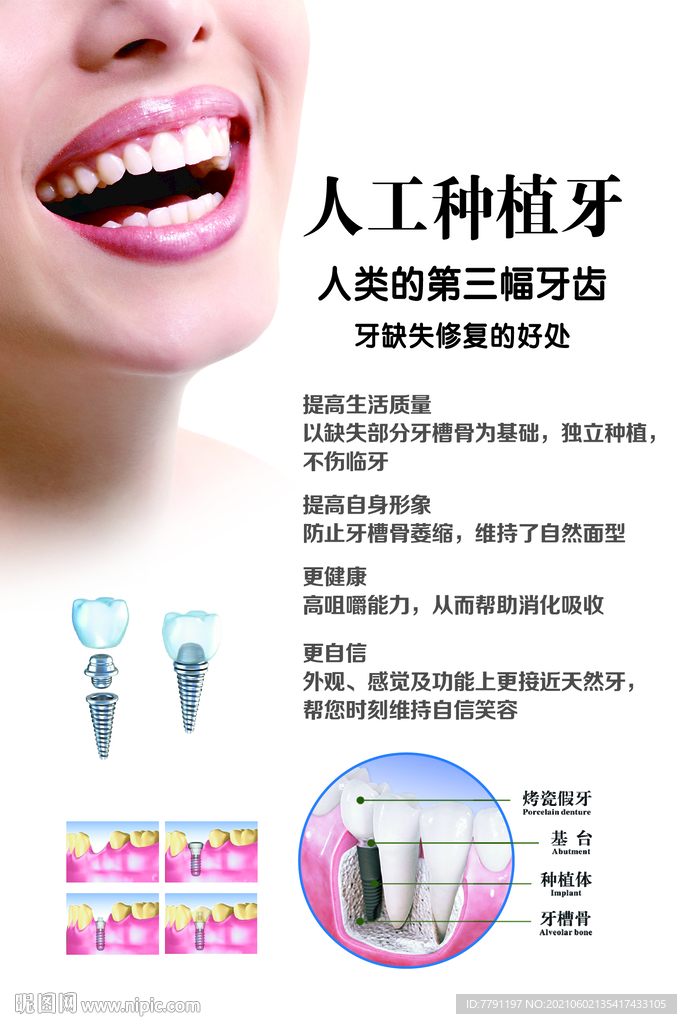 人工种植牙