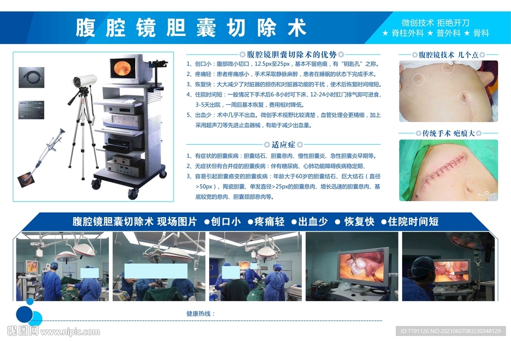 腹腔镜胆囊切除术