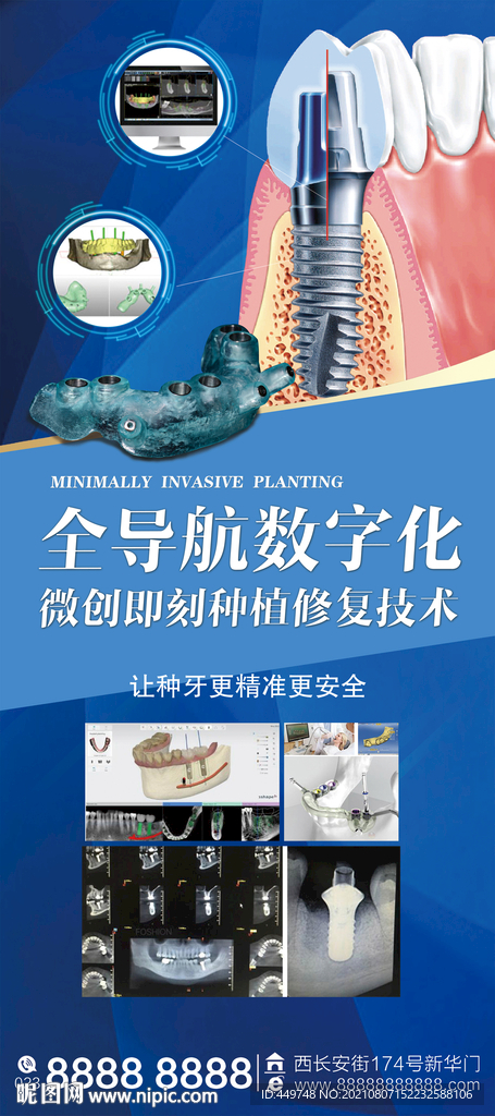 全导航数字化微创导板种植牙