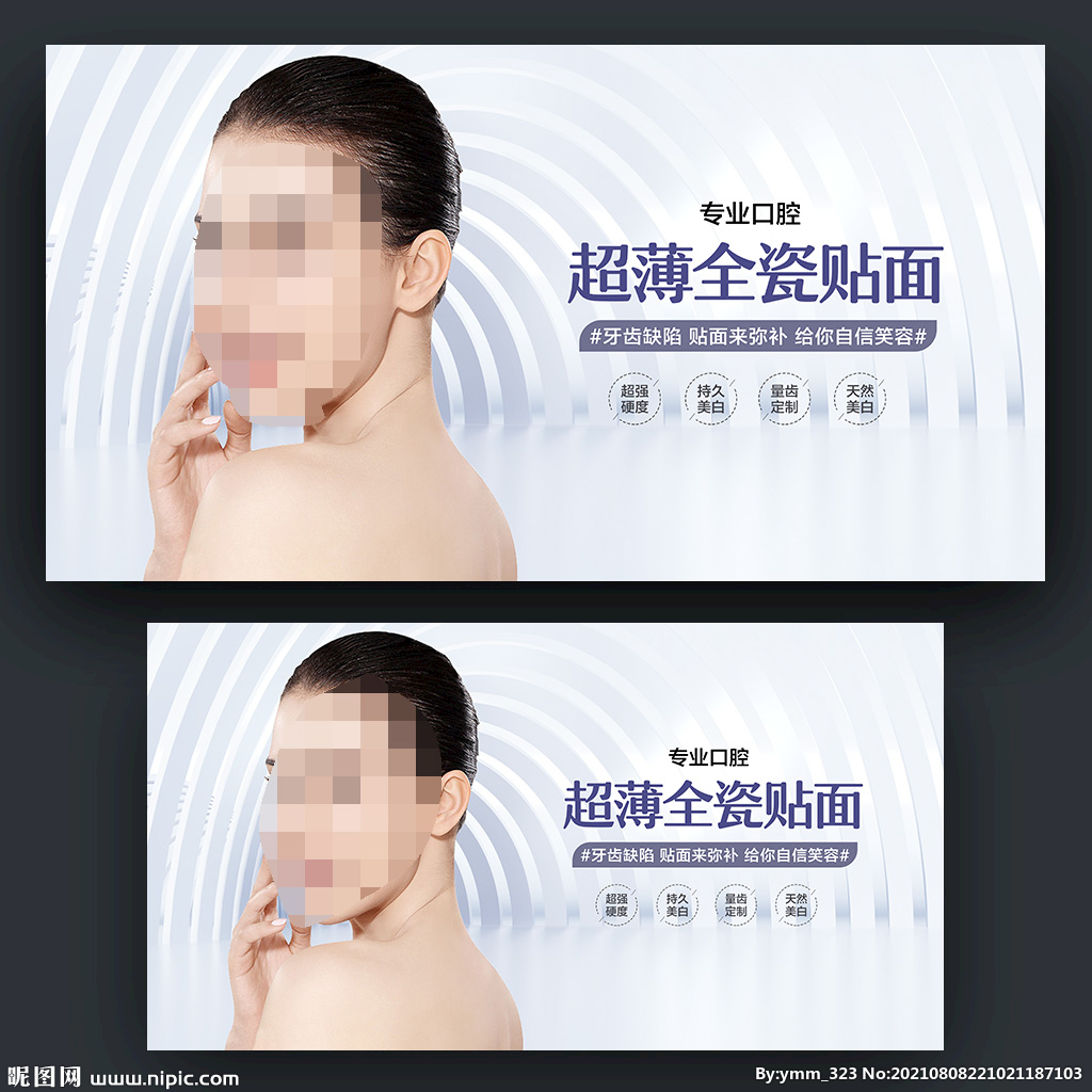 超薄瓷贴面