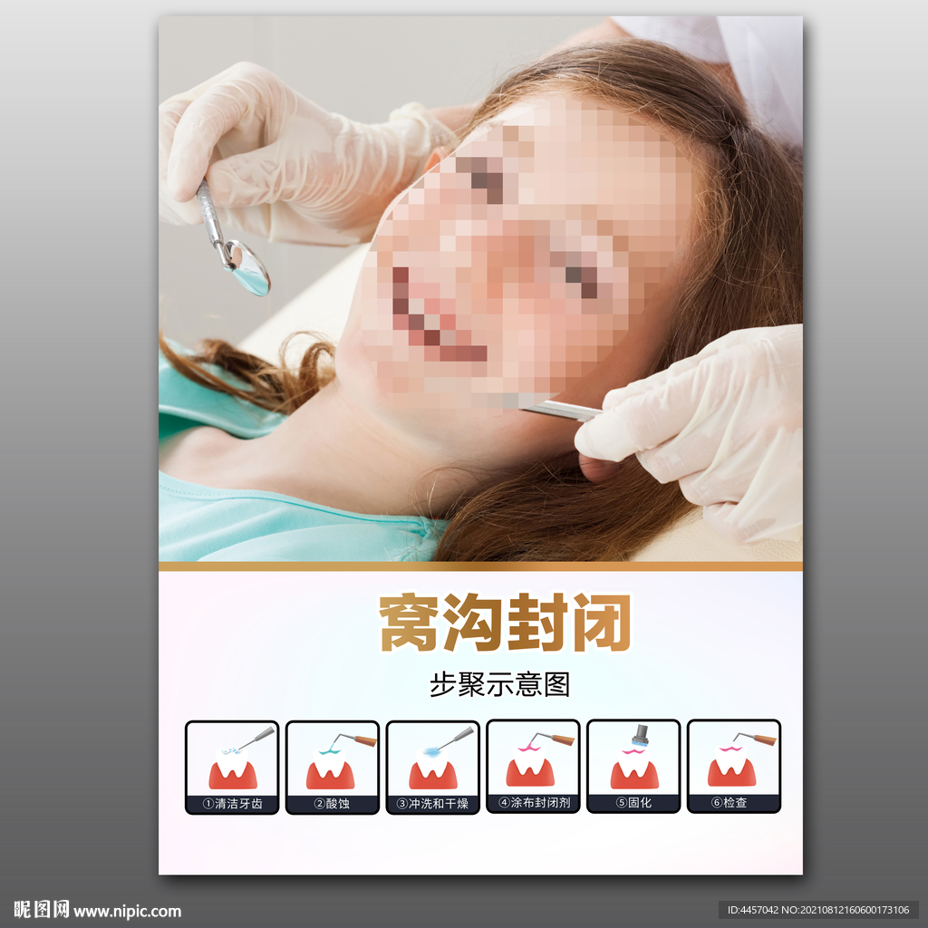 窝沟封闭