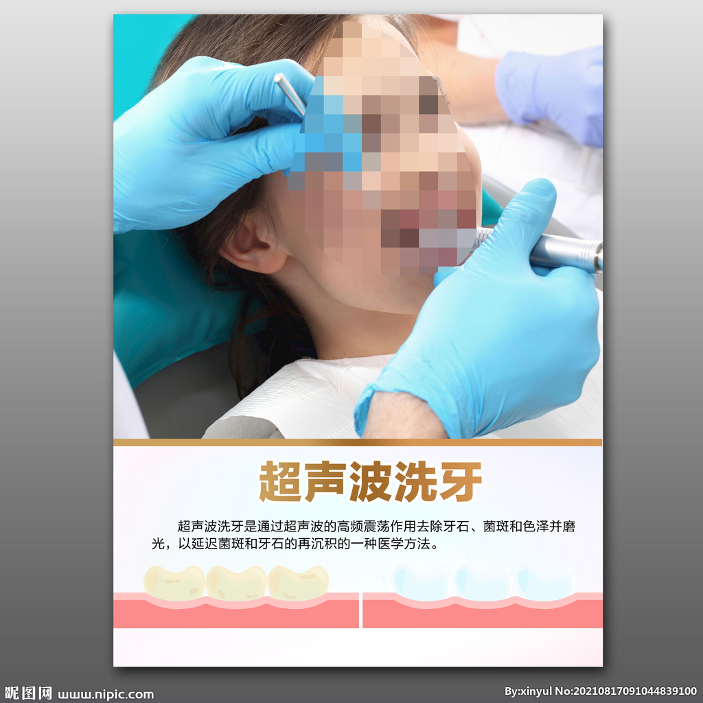 超声波洗牙