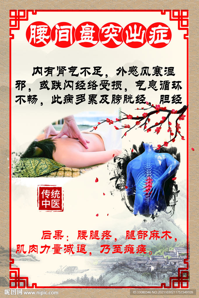 腰间盘突出