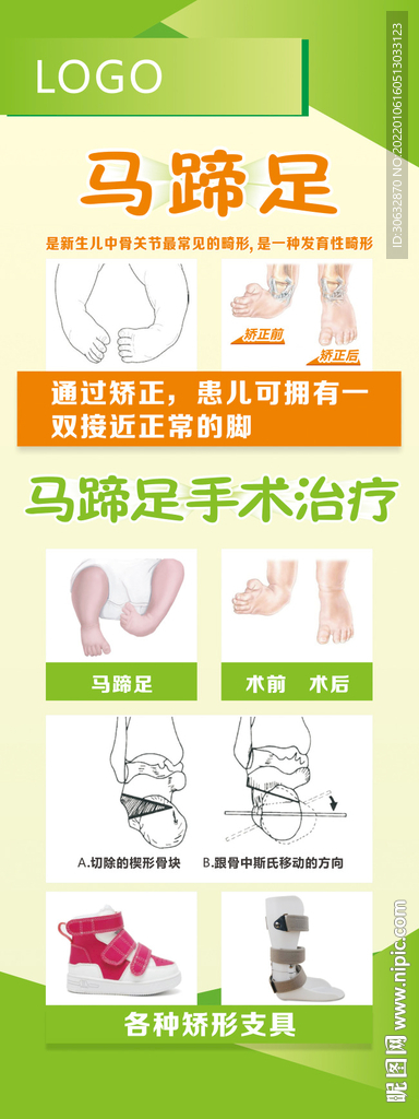 马蹄足手术治疗
