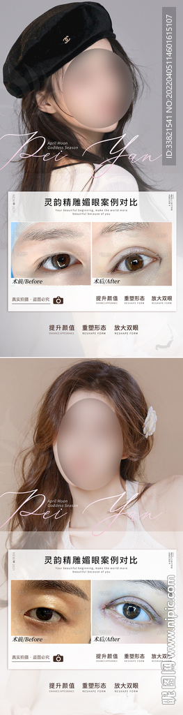 双眼皮案例对比图