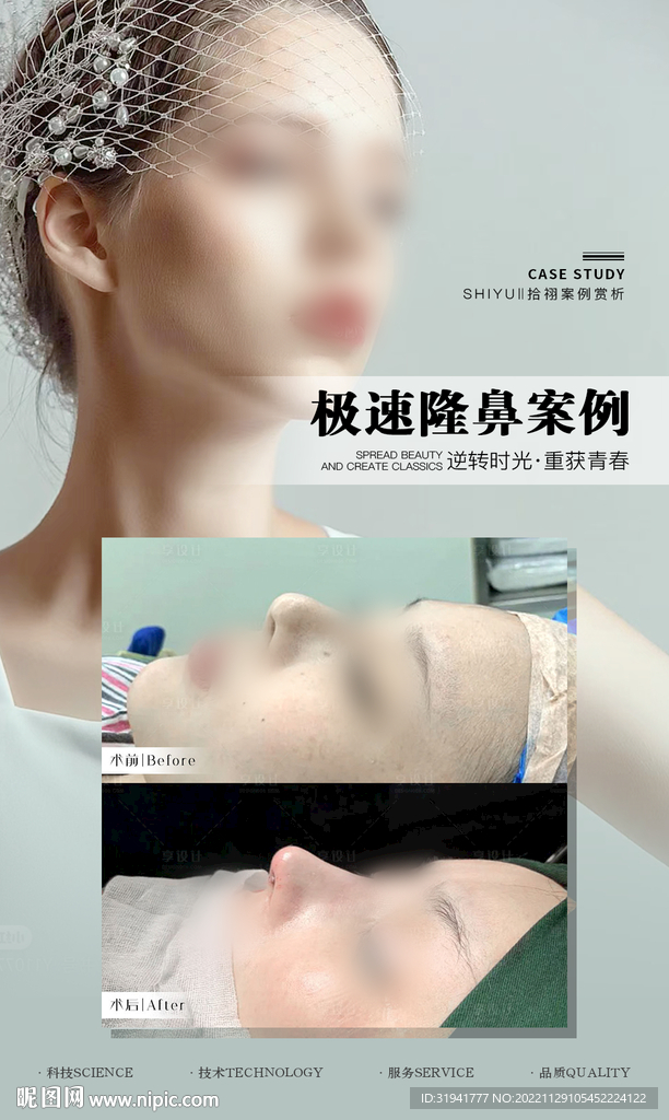 隆鼻案例