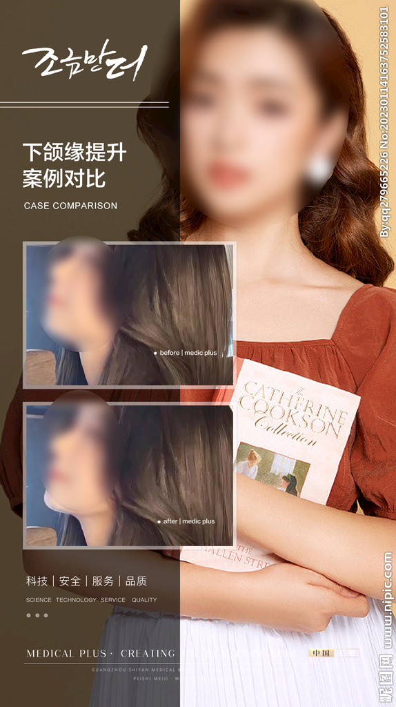 下颌缘提升案例