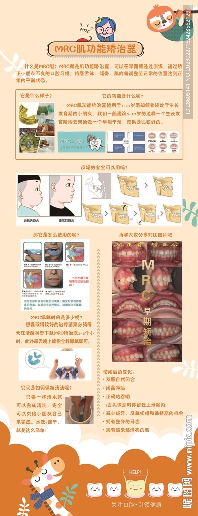 mac肌功能矫治器