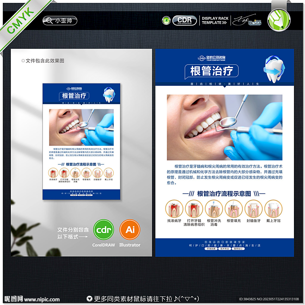 根管治疗
