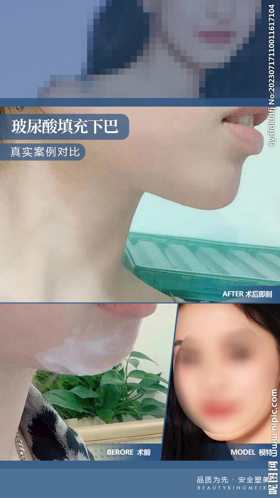 玻尿酸填充下巴