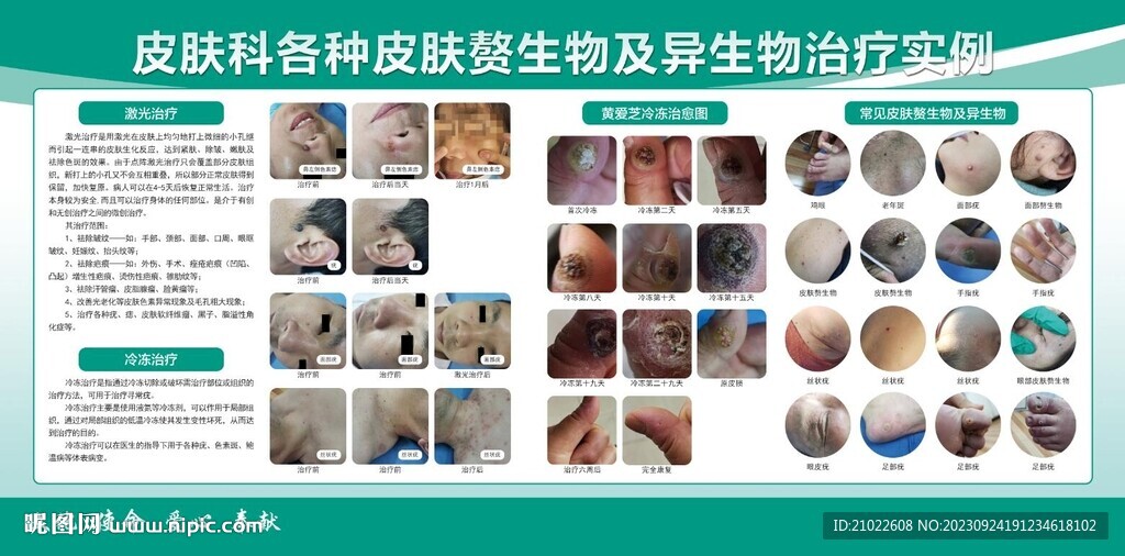 皮肤科各种皮肤赘生物及异生物治