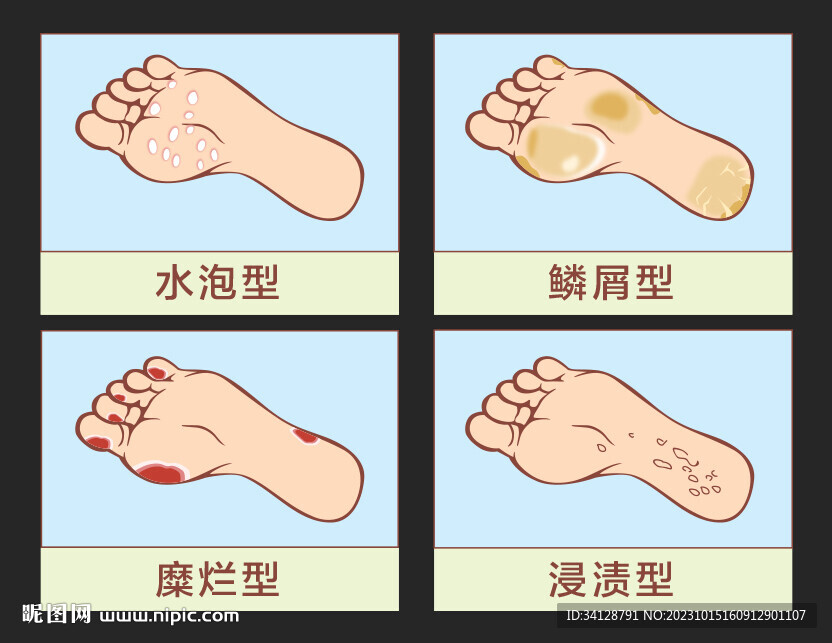 脚气类型