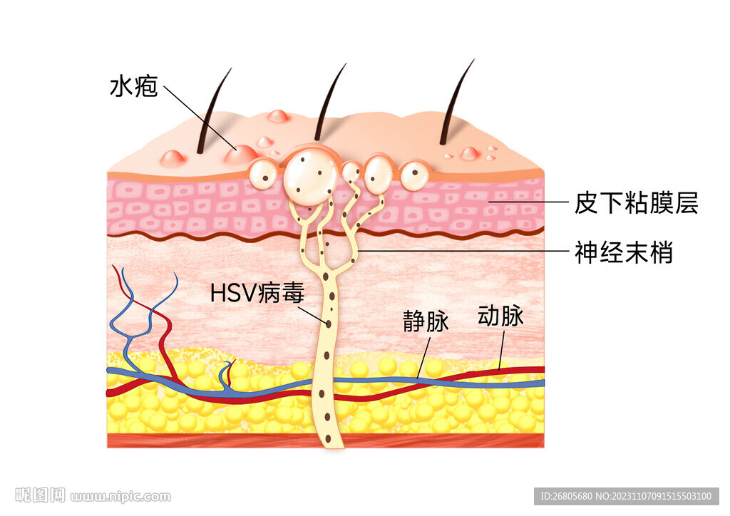 生殖疱疹皮肤示意图