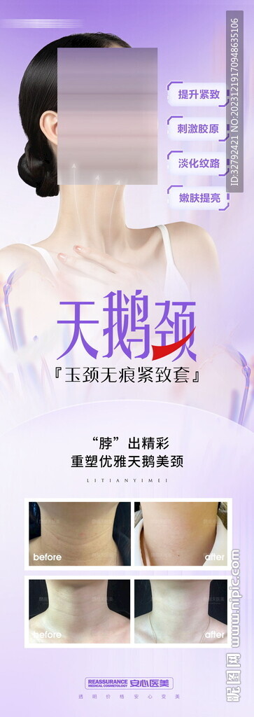 天鹅颈颈部年轻化宣传图