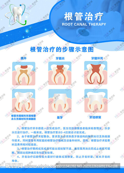 根管治疗
