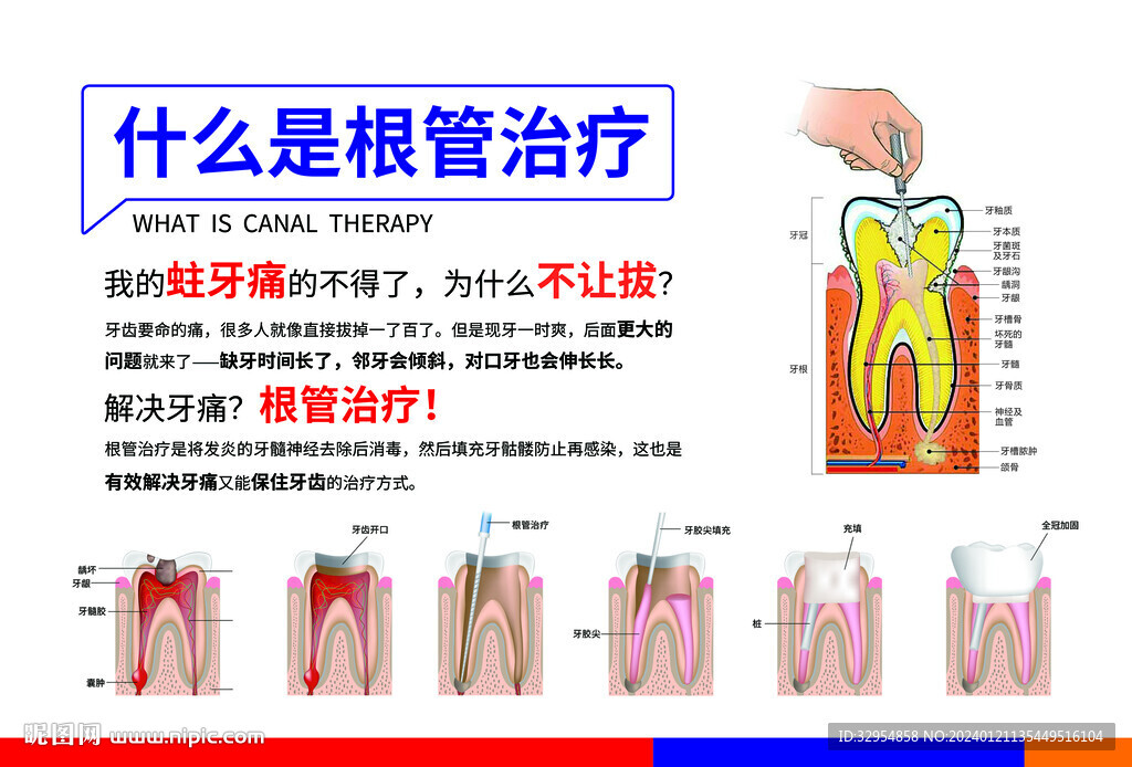 根管治疗