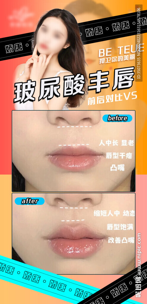 医美玻尿酸丰唇案例