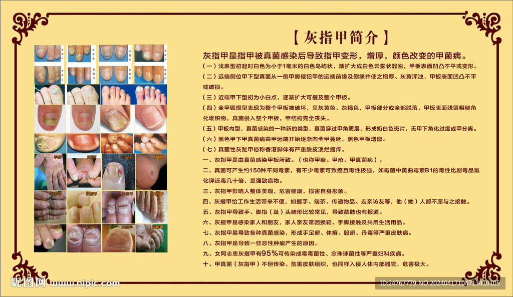 灰指甲简介