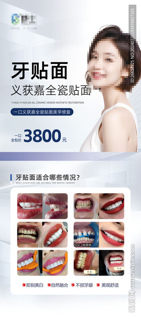 口腔瓷贴面牙贴面易拉宝