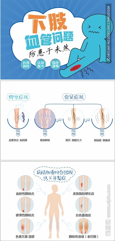 静脉曲张症状