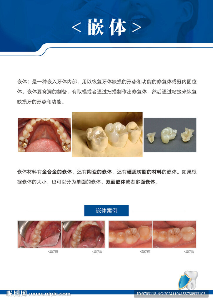 口腔  嵌体