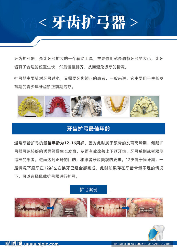 牙齿矫正  牙齿扩弓器