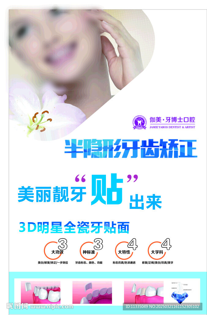 牙齿贴面