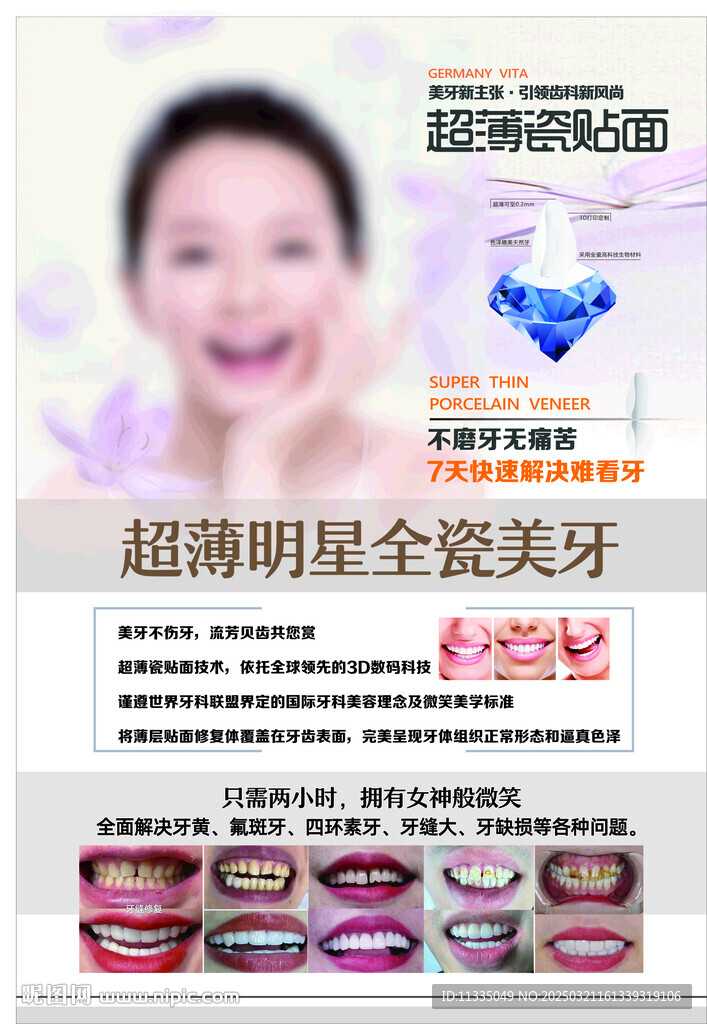 牙齿贴面