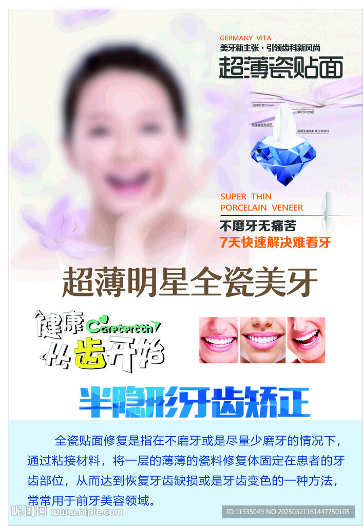 牙齿贴面