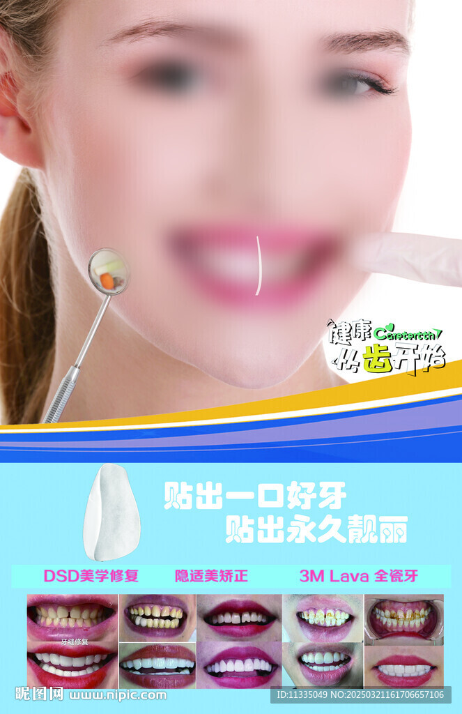牙齿贴片